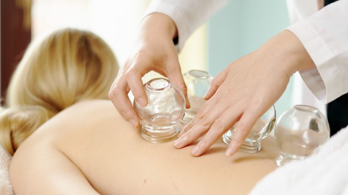 An image of a practitioner carefully placing glass cupping cups on a person’s back.